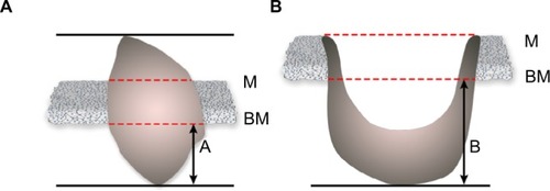 Figure 1 Measurement methods for depth of invasion from basement membrane to the deepest point of tumor: dimension A in exophytic specimen (A) or dimension B in ulcerative specimen (B).Abbreviations: BM, basement membrane; M, mucosal surface.