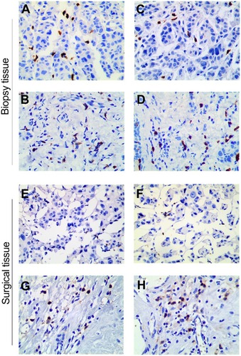 Figure 3 Histologic patterns of lymphocyte infiltrate in a breast cancer case included in this study (400×). (A, C) iCD4+ and sCD4+ in core biopsies prior to NAC; (B, D) iCD8+ and sCD8+ in core biopsies prior to NAC; (E, G) iCD4+ and sCD4+ in surgical tissues after NAC; and (F, H) iCD8+ and sCD8+ in surgical tissues after NAC.Abbreviations: iCD4+, intratumoral CD4+ tumor-infiltrating lymphocyte; iCD8+, intratumoral CD8+ tumor-infiltrating lymphocyte; sCD4+, stromal CD4+ tumor-infiltrating lymphocyte; sCD8+, stromal CD8+ tumor-infiltrating lymphocyte.