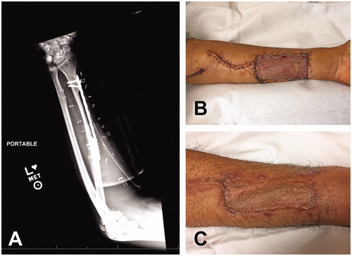 Figure 4. Donor site of osteocutaneous radial forearm free flap. (A) Use of reconstruction plate to protect radius bony defect after flap harvest. Two distal bicortical and three proximal bicortical screws were placed. (B) Intraoperative view of donor site of left forearm. (C) Long-term follow-up.