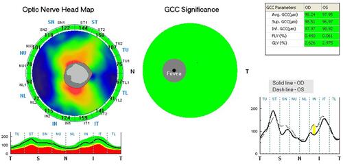 Figure 1 GCC thickness analyzed by horizontal segmentation with the RT-vue OCT.