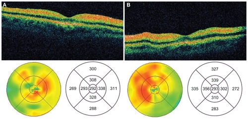 Figure 2 OCT images of the macula of the right a) and left b) eyes 72 hours postingestion demonstrating marked thickening and hyper-reflectivity of the inner retina.