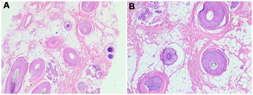 Figure 11 Hematoxylin and eosin stain of the vertex zone of Patient 3 at fourteen weeks after stopping oral minoxidil and using twice-daily topical Gashee as sole therapy. The transverse section magnification X2 (A) and magnification X4 (B) show follicles with mixed anagen and catagen phase as well as several vellus hair follicles, with increased adipocytes and absence of inflammation.