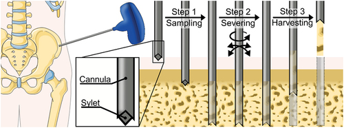 Figure 1. Schematic representation of a bone biopsy procedure. Illustration adapted from servier medical art by Servier, licensed under a Creative Commons Attribution 3.0 Unprotected License.
