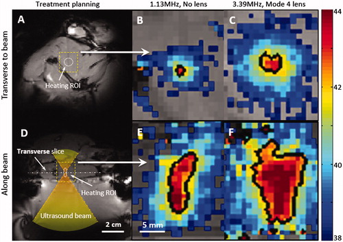 Figure 5. Zoomed-in spatial heating patterns(within the dotted boxes in A, D) measured in a rat thigh with a bare transducer operating at 1.13MHz (B, E) or a mode 4 lens operating at 3.39 MHz (C, F). The temperature maps were acquired at 10 min after sonication. The top panels show the heating transverse to the beam in the focal plane, and the bottom panels show the heating along the beam. Panels A and D depict the process of treatment planning and the location of heating ROI. The black contour indicates the 42 _C isotherm.