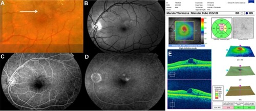 Figure 53 (A) Color fundus photograph of localized parafoveal telangiectasis. (B–D) Fluorescein angiography shows hyperfluorescence (D) due to late extravasation of the fluorescein dye. (E) The Cirrus™ optical coherence tomography image shows a intraretinal cyst as a low-reflective intraretinal area, secondary to parafoveal telangiectasis.