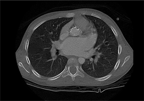 Figure 1 Cardiac CT scan showing calcification of the aorta.