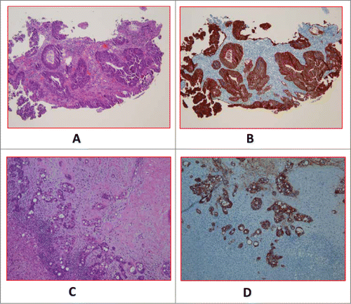 Figure 1. A (H&E) and 1B (EpCAM). Primary tumor of a case with baseline CTC of 56.33 ± 7 .06. (H&E) and 1D (EpCAM). Metastatic tumor of a different case with baseline CTC of 0.