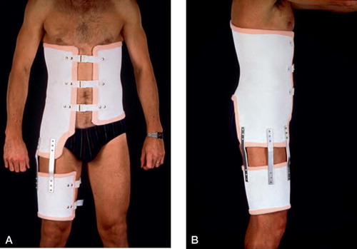Figure 10:3 Molded, rigid lumbar orthosis made of light weight material extended to one thigh immobilizing one hip. A. Anteroposterior view. B. Lateral vew. (Reproduced with permission from Spine).
