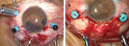 Figure 4 Representative surgical images of the (A) L-shaped incision and (B) frown incision.