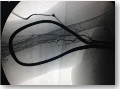 Figure 2 Synthetic axillo–axillary graft in polytetrafluoroethylene material.