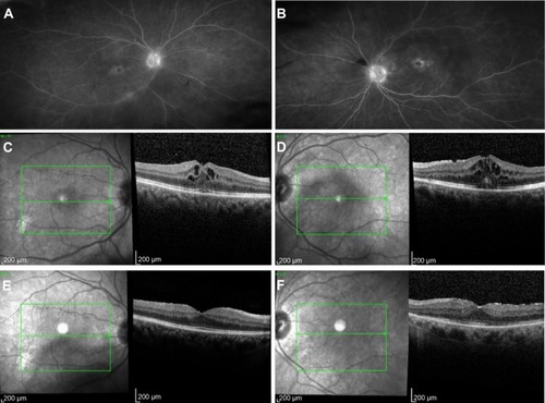 Figure 1 Resolution of cystoid macular edema following bilateral implantation of sustained-release dexamethasone intravitreal implants in patient with idiopathicnoninfectious posterior uveitis.