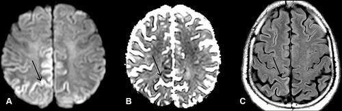 Figure 1 MRI brain on first admission. (A) (diffusion weighted imaging, DWI) and (B) (apparent diffusion coefficient, ADC): right > left restricted diffusion of parietal lobe (open arrows). (C) (fluid-attenuated inversion recovery, FLAIR): hyper-intense signal in right precuneus and parietal lobe (closed arrow), sparing white matter.
