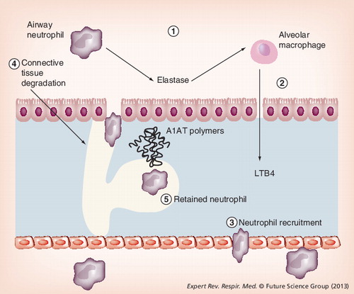 Figure 3. Mechanism of lung disease in α-1-antitrypsin deficiency.Local deficiency of A1AT leads to excess unopposed neutrophil elastase activity (1). Elastase binds to macrophages stimulating release of leukotriene-B4 (2), a potent neutrophil chemotactic mediator. This promotes neutrophil recruitment (3), causing further release of neutrophil elastase and tissue damage (4). In addition, mutant A1AT polymers colocalize with neutrophils, retaining them in the interstitium and promoting further connective tissue degradation (5).