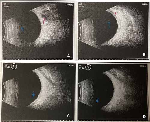 Figure 3 Ocular ultrasound examinations on days 1 (A and B) and 6 (C and D). Red arrows show the hypoechoic dark areas in the peripheral spherical walls of both eyes. Blue arrows show the punctate echoes in the vitreous humor. OD, right eye. OS, left eye.