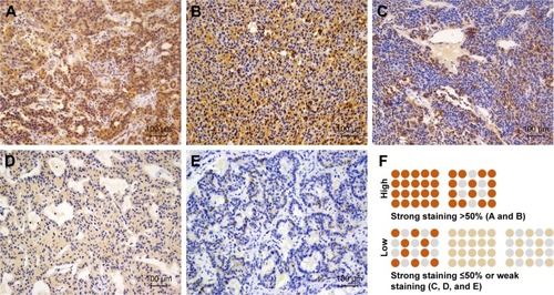 Figure 2 Immunohistochemical staining results of LKB1 expression in pNET tissue samples.