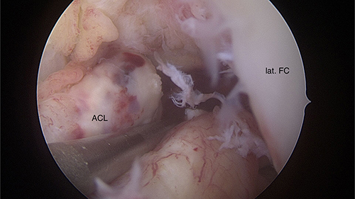 Figure 2 Arthroscopy, notch; ACL tear.