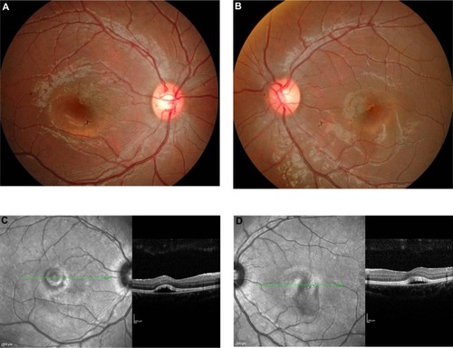 Figure 2 (A–D) Case 2. Color fundus photograph of the right (A) and left (B) eyes showing dome-shaped elevation of the foveal regions, with the presence of yellowish deposits, signifying Best’s vitelliform macular dystrophy. Optical coherence tomography of the right (C) and left (D) eye revealed the presence of subretinal fluid at the foveal regions. Green lines indicate the cross-section of the macula shown by the adjacent optical coherence tomography image.