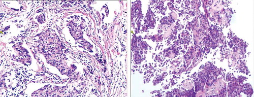 Figure 1. (a) Postoperative pathology revealed invasive ductal carcinoma (HE, 100× magnification). (b) Immunohistochemical staining of the resected specimen showed ER (1+), PR (-), HER-2 (2+), fish (-), Ki-67(20%~30%). Postoperative pathology revealed invasive ductal carcinoma (HE, 100× magnification). Immunohistochemistry showed ER (-), PR (-), HER-2 (-), Ki-67(50%)