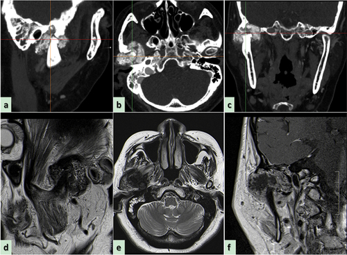 Figure 2. Preoperative computed tomography scan reveals the wormlike osteolysis of the right condylar head presenting with swelling, cloudy flocculent ground-glass opacity, relatively clear boundary, thin bone in the middle of the cranial fossa, low continuity, and involving the temporomandibular joint. (a) Computed tomography (CT) sagittal plane, (b) CT axial plane, (c) CT coronal plane. (d) Preoperative magnetic resonance imaging reveals the lesion exhibiting hypointensity, presenting as an oval soft tissue shadow on the sagittal T1-weighted image. (e) Heterogeneous hyperintensity on the axial T2-weighted image and (f) T1-enhanced weighted image in the coronal position shows ring enhancement.