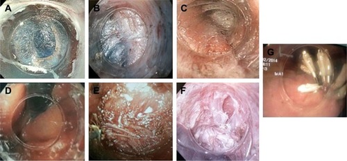 Figure 1 Stages of anterior POEM: (A) longitudinal mucosal incision at the second hour. (B) Submucosal tunnel. (C) Identification of EGJ inside the tunnel (palisade vessels). (D) Blue dye is recognized at retroversion in the gastric cardia. (E) Selective circular myotomy is performed using TT knife. (F) External longitudinal muscle layer is recognized at the back of the myotomy side. Longitudinal muscle fibers split each other. (G) Mucosal entry closing by clips at the completion of myotomy.