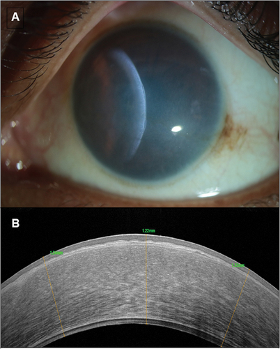 Figure 4. Shows the slit-lamp biomicroscopy photographs of- congenital hereditary endothelial dystrophy, with the ground-glass appearance of the cornea with the slit beam suggestive of increased corneal thickness (a). Anterior segment OCT shows CHED with a thickened epithelial layer with underlying irregular bowman’s membrane, increased stromal thickness and abnormally thickened Descemet membrane (b).