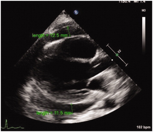 Figure 3. Trans-thoracic echocardiogram (ECHO) on Day 14: pericardial effusion.