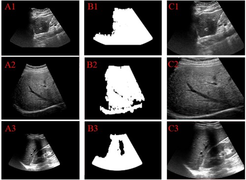 Figure 3. Test results of ROI extraction method on the ultrasound images from the different ultrasound machines. (A1)–(A3): original images, (B1)–(B3): the result of the open operation, (C1)–(C3): the final ROI result.