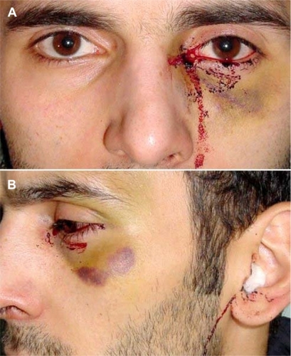 Figure 1 (A) Bloody tears in the left eye and hematomas on left periorbital region. (B) During attacks, the patient had hemorrhage from the left external auditory meatus and epistaxis.