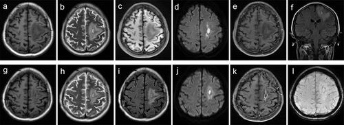 Figure 2 Brain magnetic resonance imaging of patient 5. Brain magnetic resonance imaging performed 11 days after clinical onset showed lesions in the left frontal lobe with edema (a–c and f). Restricted diffusion in the necrotic component on diffusion-weighted images (d), and mild enhancement on contrast-enhanced images (e). The brain magnetic resonance imaging 1 month after clinical onset showed lesions in the left frontal lobe slightly shrunk (g–i). Diffusion-weighted images showed restricted diffusion in the necrotic center (j), ring enhancement on contrast-enhanced images (k), and ring low signal in the necrotic component on susceptibility-weighted images (l).