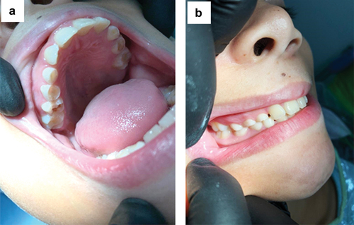 Figure 1. Wear in the deciduous dentition in a pediatric patient. (a) occlusal wear in posterior teeth; (b) patient in occlusion showing the wear of the cusps of the deciduous elements.