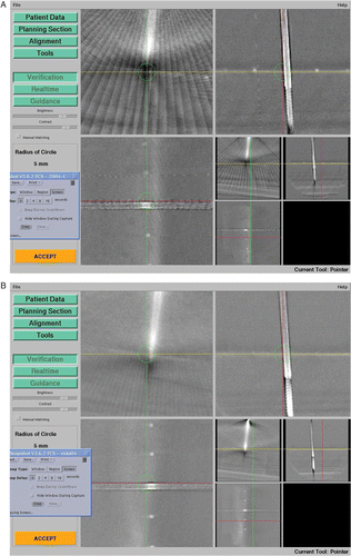 Figure 2. A) Screenshot showing artifacts seen with the use of a stainless steel Schanz screw. The PVC markers can be seen clearly. B) A titanium Schanz screw results in fewer artifacts, and the PVC markers can be seen clearly. [Color version available online.]