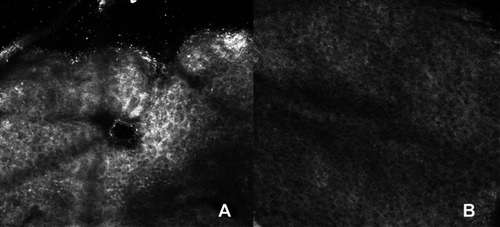 Figure 3 Reflectance confocal microscopy (RCM). (A) pustular lesion show inflammation of the follicle with characteristic bright dots inside and around the infundibulum. (B) after treatment, RCM show normal hair follicle with regular non-reflective borders.