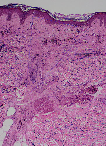 Figure 5 Histopathology of lichen planopilaris shows wedge-shaped perifollicular fibrosis with loss of elastic fibers (blue triangle) corresponding to the white fibrotic dots (VVG, X100).