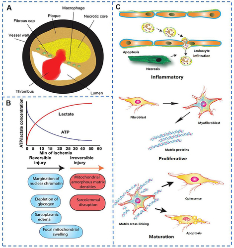 Figure 7 Causes of myocardial infarction and repair of myocardial tissue. (A) The “fragile plaque” model. Myocardial infarction is usually caused by the formation of occlusive thrombi in the coronary arteries due to rupture of fragile plaques; (B) early evidence of irreversible myocardial cell damage in ischemic myocardium: as ATP levels decrease, myocardial cells can no longer maintain their structural integrity and exhibit ultrastructural changes of damage, such as disruption of myocardial cell membranes and the presence of amorphous density of mitochondria; (C) The repair process after myocardial infarction. The repair process after myocardial infarction. Alarmins released by necrotic cardiomyocytes (alarm hormones, that is, endogenous biological mediators released by white blood cells and epithelial cells to the outside of the cell when the body is in the state of tissue injury and inflammatory response or physiological stress, which can enhance the immune response) trigger a strong inflammatory response to clear the dead cells and stromal debris in the infarction area. Removal of dead cells inhibits pro-inflammatory signaling and the transition to the proliferative phase. Conversion of fibroblasts into myofibroblasts and deposition of extracellular matrix proteins form an abundant neovascular network. Finally, during maturation, the extracellular matrix is hooked up, while the infarcted fibroblasts become quiescent and may undergo apoptosis. Reproduced from Frangogiannis NG. Pathophysiology of Myocardial Infarction. In: Terjung R, ed. Comprehensive Physiology. 1st ed. Wiley; 2015:1841–1875. © 2015 American Physiological Society.Citation110