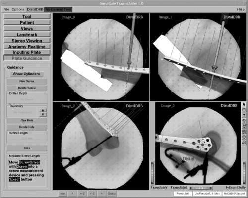 Figure 4. User interface with visualization of X-ray dynamization and three-dimensional representation of a fracture fixation plate.
