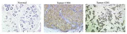 Figure 4. Cullin-3 is overexpressed in human breast cancer. Breast tumor #904 and #281 and normal breast tissue were cut and stained for Cullin-3 protein by IHC (x20).