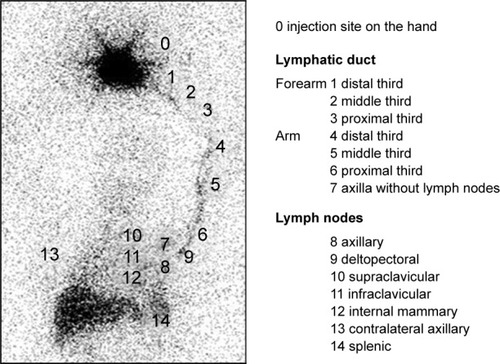 Figure 1 Lymphoscintigraphy including the area from the hand to the abdominal region.Source: Reprinted with permission from Sarri AJ, Moriguchi SM, Dias R, et al. Physiotherapeutic stimulation: Early prevention of lymphedema following axillary lymph node dissection for breast cancer treatment. Exp Ther Med. 2010;1(1): 147–152.Citation29