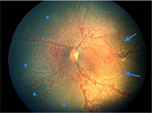Figure 4 Left eye of a female infant born at 32 weeks weighing 1,400 g shows aggressive posterior ROP.