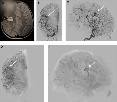 Figure 4 (A) Brain MRI showing hemorrhage in the right frontal lobe. (B and C) Cerebral angiography showing the right frontal AVM supplied by M5 branch of the right MCA and draining into a cortical vein emptying into right superficial sylvian vein. (D and E) Cerebral angiography after endovascular devascularization showing the significant regress of the AVM.