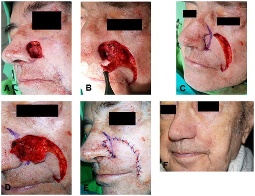 FIGURE 1. Different steps of the operation. A: preoperative status, B: dissection of the subcutaneous and cutaneous pedicled flap, C: temporarily situated flap, blue ink shows the position of alar-facial groove on the skin flap, D: alar-facial groove is fixed with 5/0 absorbable sutures, E: the flap is sutured into the defect, F: late postoperative status.