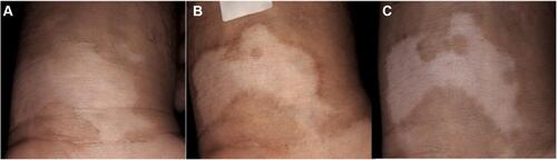 Figure 3 Vitiliginous lesion on left wrist treated with needling (A) initial surface area of 10.2 cm2. (B) 22.5% Repigmentation after 3 months, with partial marginal hyperpigmentation. (C) 51% Repigmentation at 6 months.