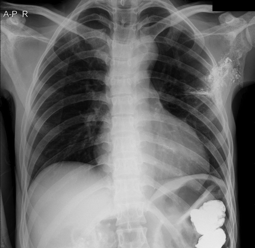 Fig. 1. Initial chest x-ray at tertiary hospital showed multiple metallic fragments in his left scapula, left upper lung, and left 4th and 5th ribs. The residual barium contrast, from recent barium enema study in the 9th week post injury, was still remained in descending colon.