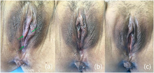 Figure 1. Changes in clinical signs before and after treatment. (a) Before treatment (the green arrow indicated the lesion’s location), (b) after 1 month of treatment, and (c) after 6 months of treatment, the lesions disappeared and the skin color basically returned to normal.