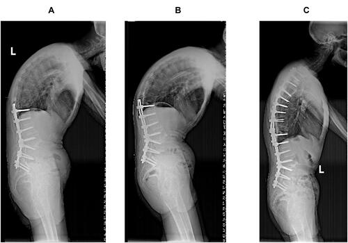 Figure 3 A 49-year-old male patient. (A) The patient is allocated to the lumbar kyphosis group before the operation. (B) Single segmental PSO surgery is performed at L2. The LL and SVA change to −56° and 63.06 mm from 8° and 312.84 mm, respectively (C). During the follow-up, no significant correction loss is observed in the final year. The LL and SVA are −56° and 70.35 mm, respectively.