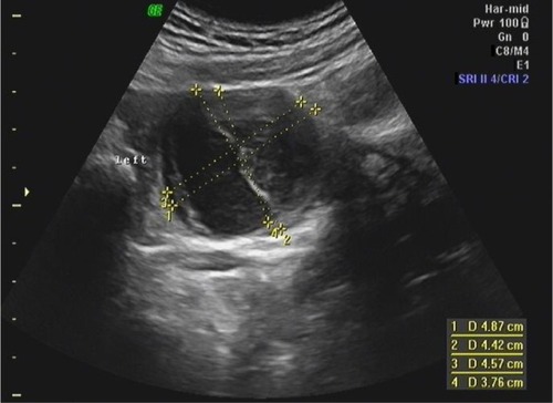 Figure 2 Transabdominal ultrasound in a 16-year-old adolescent.