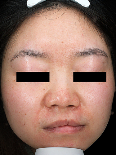 Figure 3 Facial image of the PD patient after treatment. The erythema and papules around the wing of nose and mouth were significantly improved.