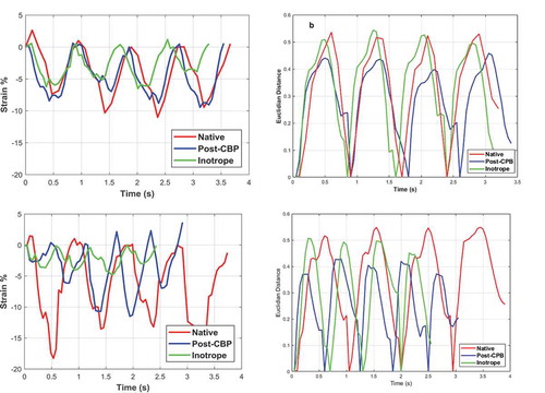 Figure 6. (a) Engineering strain and (b) Euclidian distance as a function of time for patient#1 and (c) engineering strain (d) Euclidian distance as a function of time for patient#2