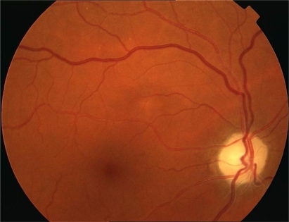 Figure 3 Optic nerve atrophy.