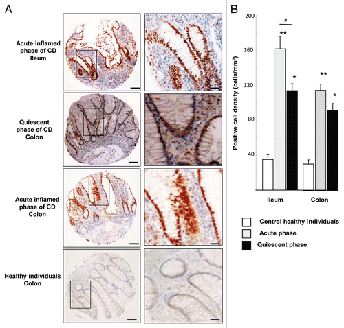 Figure 1. HIF-1α staining in intestinal biopsies of CD patients and healthy subjects. (A) Immunohistochemical (IHC) staining of tissues micro-array (TMA) from ileal and colonic biopsies of patients in acute inflamed and quiescent phase of CD. Each picture is representative of immunostaining for HIF-1α at low magnification (scale bar = 100 µm) and at high original magnification scale bar = 30 µm). IHC shows numerous HIF-1α-stained nuclei, from the bottom of the crypts to the apical surface of villi, in the epithelia of the ileum and colon of CD-patients. (B) Quantification using the Spot Browser software of HIF-1α immunostaining on TMA from colonic and ileal biopsies of 85 patients in the acute phase of CD, 95 patients in the quiescent phase of CD, and 48 control subjects *p < 0.01, **p < 0.001 CD patients vs. healthy subjects; # p < 0.01, ileum of acute inflamed phase vs. quiescent phase of CD patients. TMA quantification shows that HIF-1α positive cell density was increased in ileum and colon of CD-patients vs. control healthy individuals.