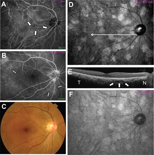 Figure 3 Fundus photographs of the right eye by indocyanine green angiography (A), fluorescein angiography (B), color fundus photograph (C), near-infrared monochromatic light resistance (D), optical coherence tomography image (E), and near-infrared fundus autofluorescence (F) of case 2. Arrows in Figure 3A show hypofluorescent regions by indocyanine green angiography. Arrows in Figure 3B show hyperfluorescent regions by fluorescein angiography. An optical coherence tomography image crossing the bright patchy regions (arrow in Figure 3D) shows an irregular hyporeflectance focus in the choroid (arrows in Figure 3E). Near-infrared fundus autofluorescence (F) shows hyperfluorescent regions of similar sizes at locations identical to those revealed by near-infrared monochromatic light resistance (D).